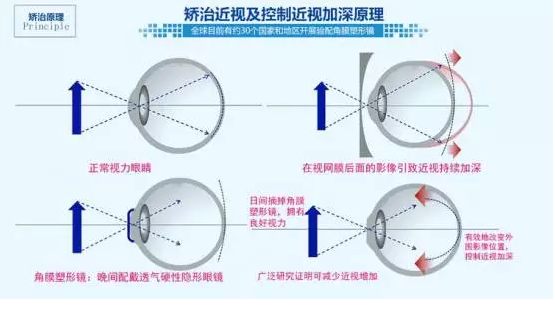 矫正镜原理是什么意思,矫正镜原理是什么意思啊