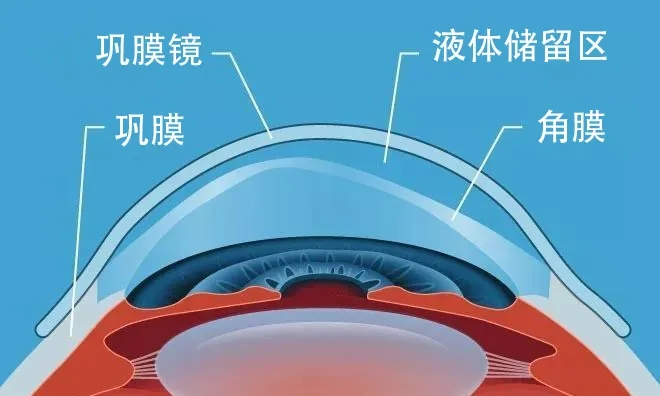 巩膜镜治疗什么眼病？